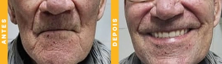 implantes dentarios em joinville 2