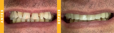 implantes dentarios em joinville 3