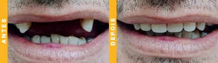 implantes dentarios em joinville